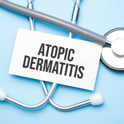 Atopic dermatitis &#8211; Symptoms and management tips