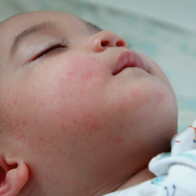 Eczema in babies, kids, and teens &#8211; Signs and management